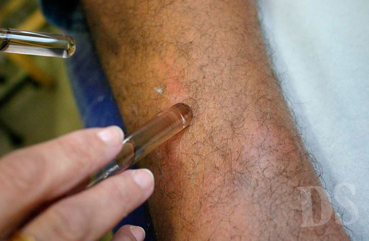 HIPERENDÊMICO – SES avança em ações de enfrentamento à hanseníase em MT